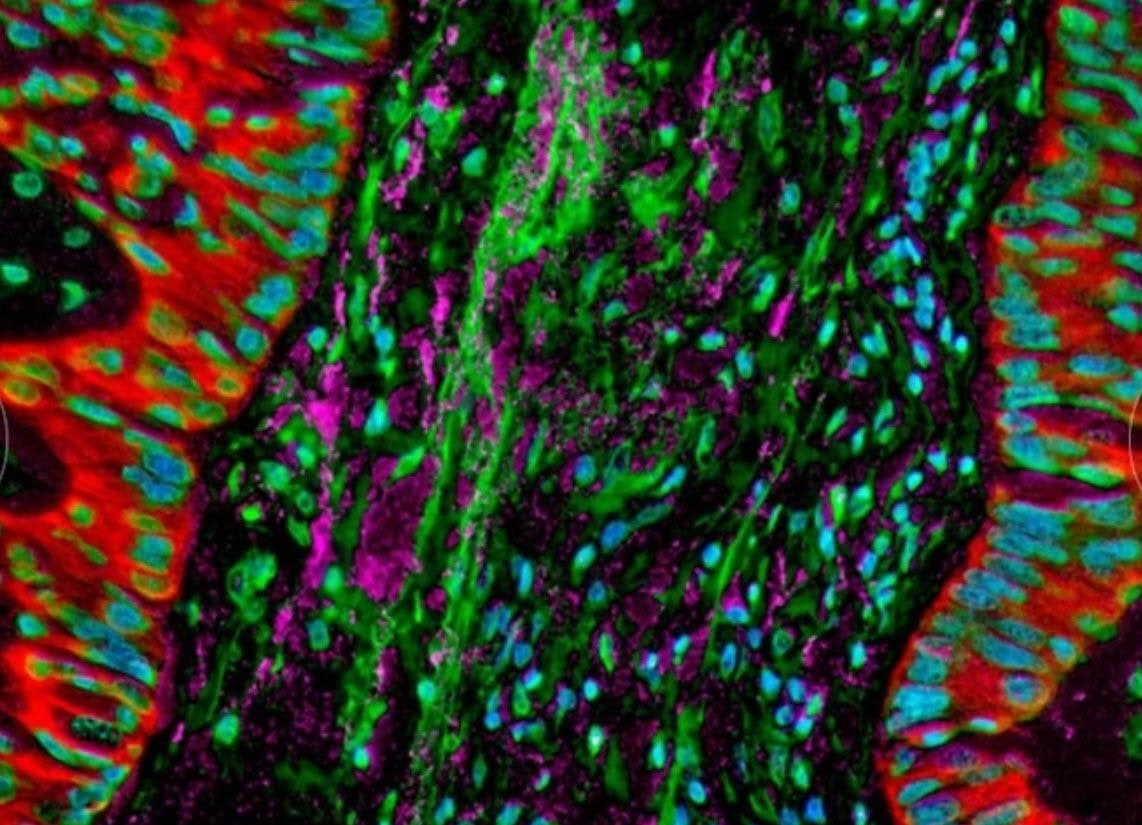 EIC Pathfinder Backs 43 Projects Including Lung Cancer Bacteria